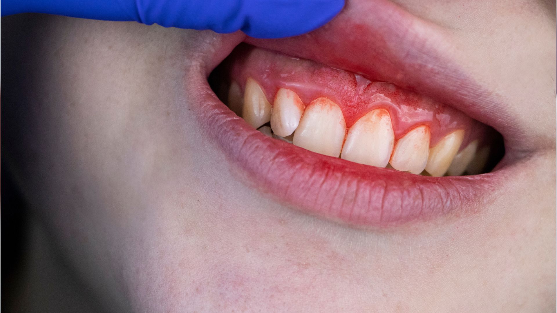 Parodontitída Aké sú príčiny vzniku, riziká a možnosti liečbya